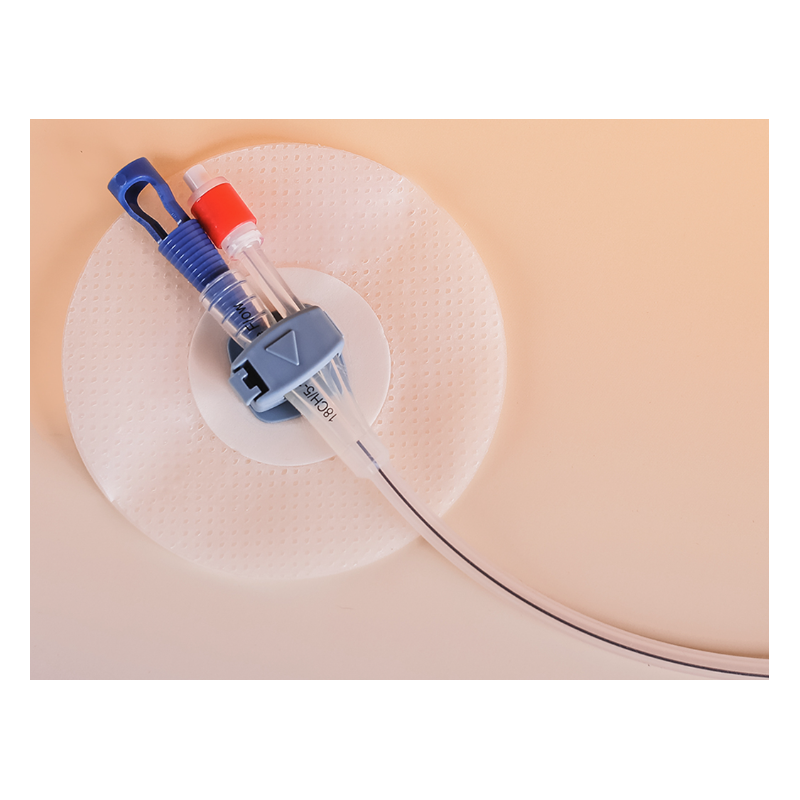 Fissazione del catetere Ugo-Fix non sterile