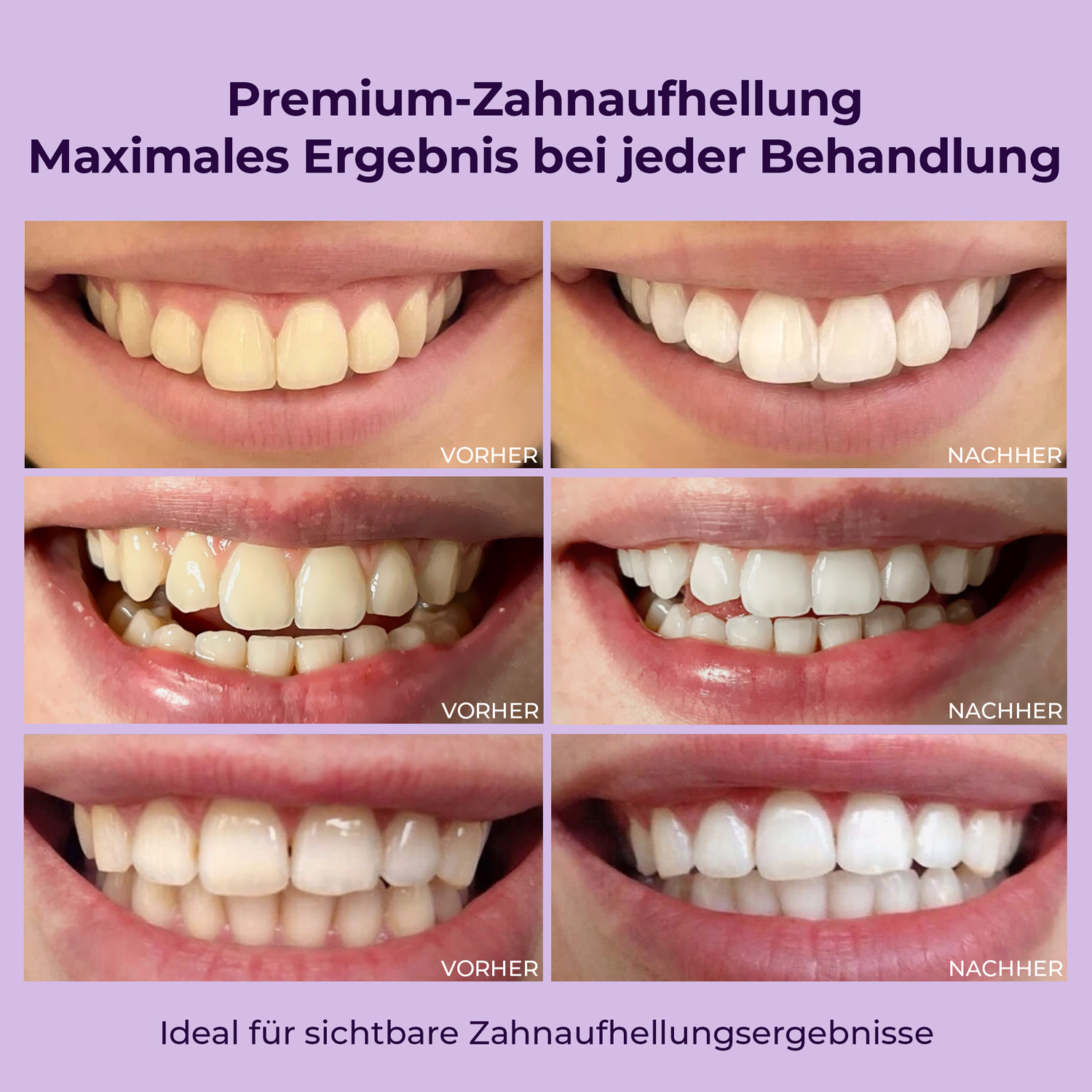 Set per lo sbiancamento dei denti OnlySmile