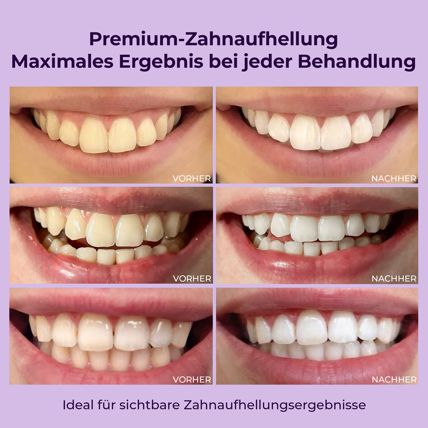 OnlySmile® gel sbiancante per denti confezione doppia 3 x 40 ml